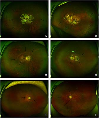 Association Between Types of Posterior Staphyloma and Refractive Error After Cataract Surgery for High Myopia